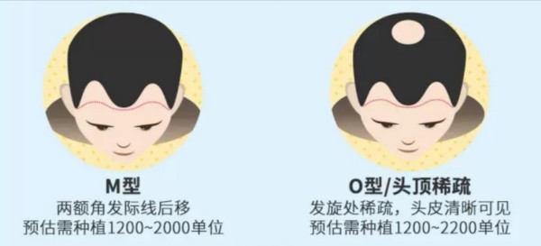 1元体验3d植发新微针微创种植200单位种植体验