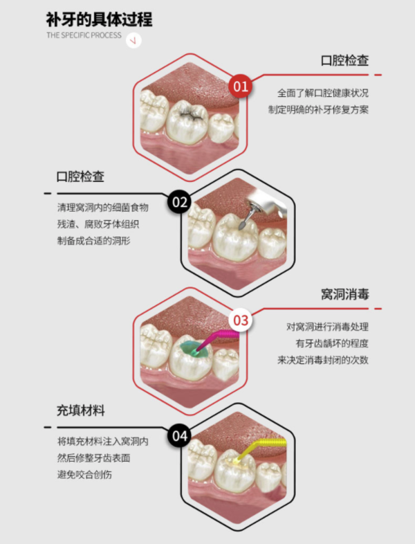 牙博士口腔3mz350进口光固化复合树脂补牙