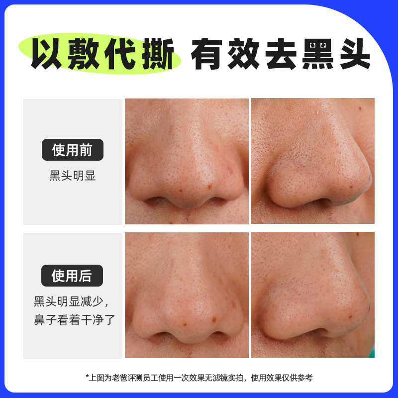 RNW 如薇 鼻贴去黑头粉刺闭口导出液收缩毛孔深层清洁男女学生官方正品