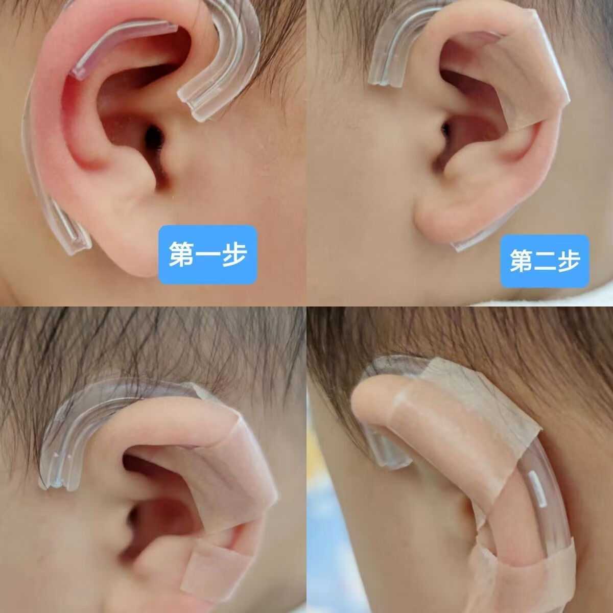 拜耳婴儿耳朵矫形器内置小儿贴耳廓贴纠正塑形耳轮定型牵引器 单耳耳撑+合金硅胶耳托+矫正贴 新生儿（小）+指导