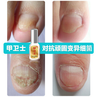 Dr.JYS脚医生甲卫士 除问题型指甲灰指甲专用液非药水去4ml