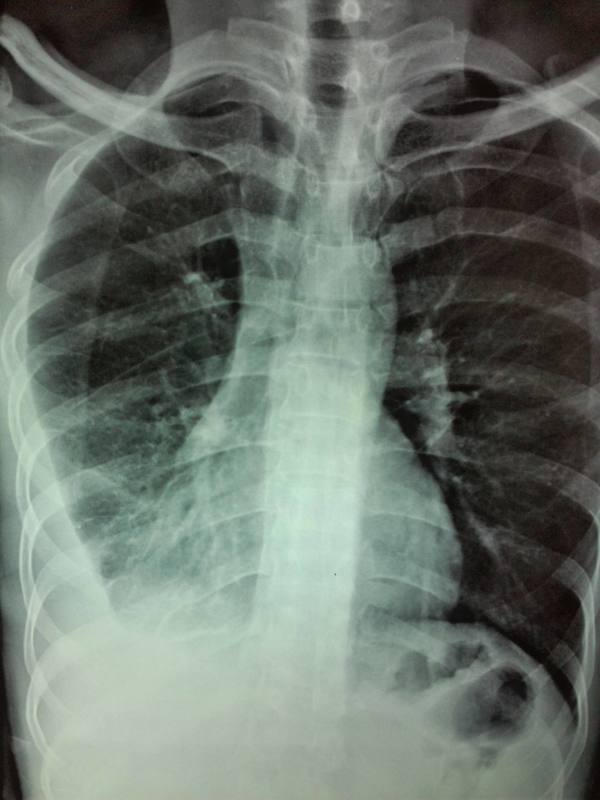 体检全知道肺癌查出就是晚期如何提早进行预防