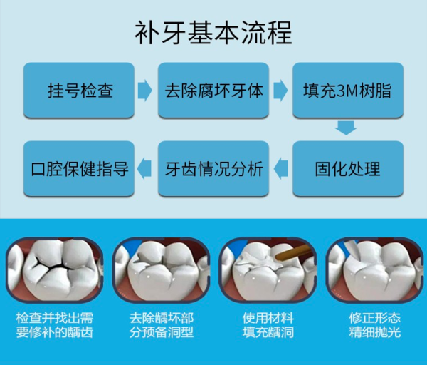 美奥口腔 3m纳米树脂补牙卡 口腔齿科套餐