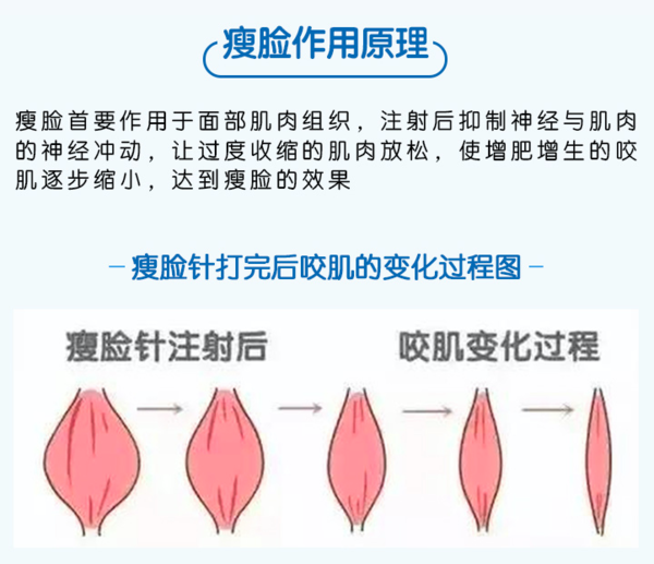 限地区：广深沪【保妥适瘦脸50U】【保妥适瘦腿100U 】赠三选一免费项目