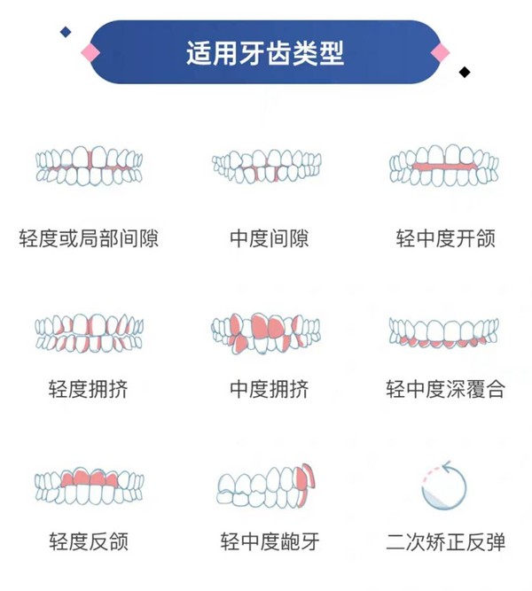 北京笑研所  隐形矫正牙套  收牙缝矫正器  透明牙套整牙