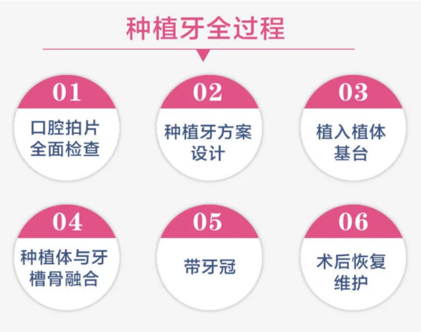 半口/全口固定种植牙 每半口6颗种植体12颗全瓷牙冠 金属基台