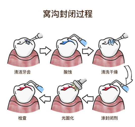 佳美口腔 儿童窝沟封闭套餐 