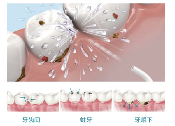 PLUS会员：劲松口腔 超声波洗牙卡 含喷砂