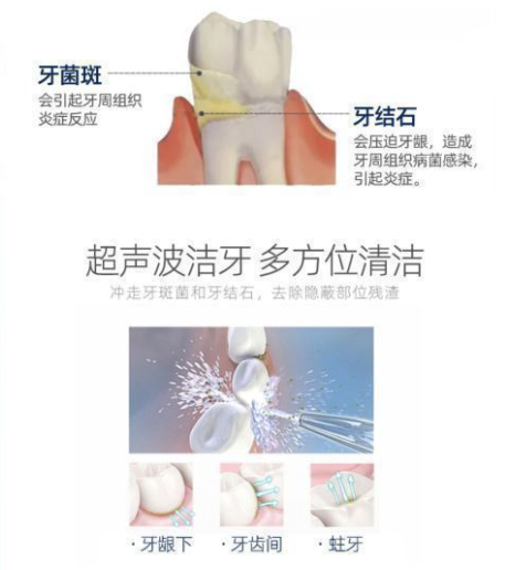 拼健康 单次洗牙 超声波洁牙