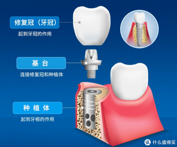 小编精选：动辄上万的种植牙，竟然也有低于5k的？