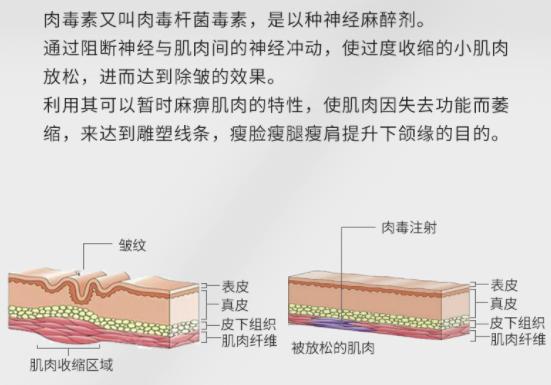 PLUS会员：奢己 美国保妥适除皱针