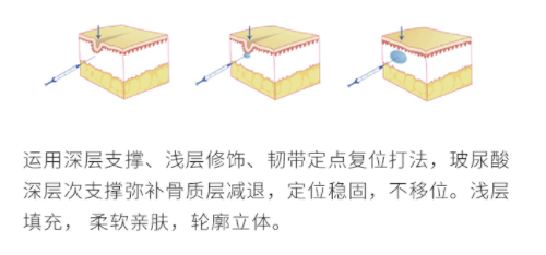 奢己 韩国艾莉薇玻尿酸注射