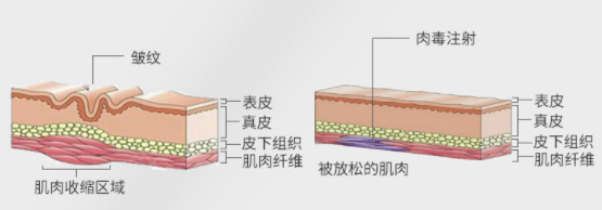 奢己 进口美国除皱 100U