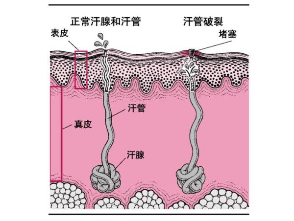 夏天太热,宝宝长痱子怎么办?-什么值得买