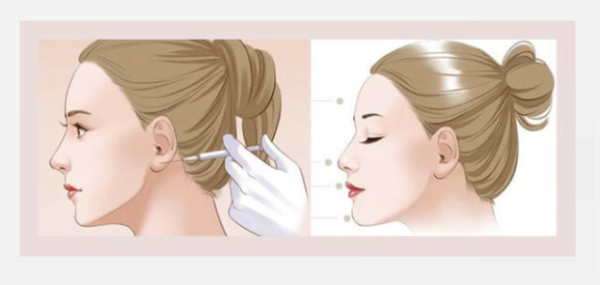 医美咖国产瘦脸下颌缘提升