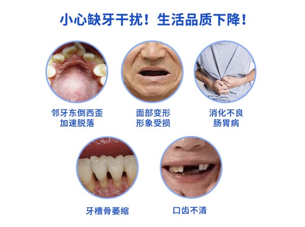 EnjoyDental 欢乐口腔 进口ABT种植牙套餐含基台牙冠