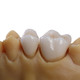 DALEK口腔 戴立克二氧化锆全瓷牙  二代进口全瓷牙