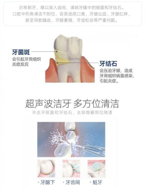 拼健康 超声波洁牙全国通用