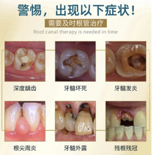 灵格口腔前牙根管治疗特惠套餐
