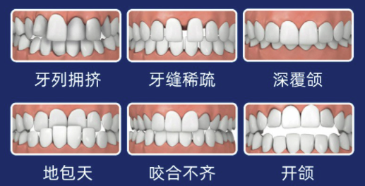 美奥口腔 国产金属托槽矫正