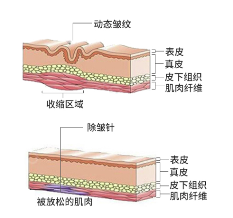 兰州衡力除皱针【限首单】（去川字纹/去木偶纹/去鼻背纹/去鱼尾纹）