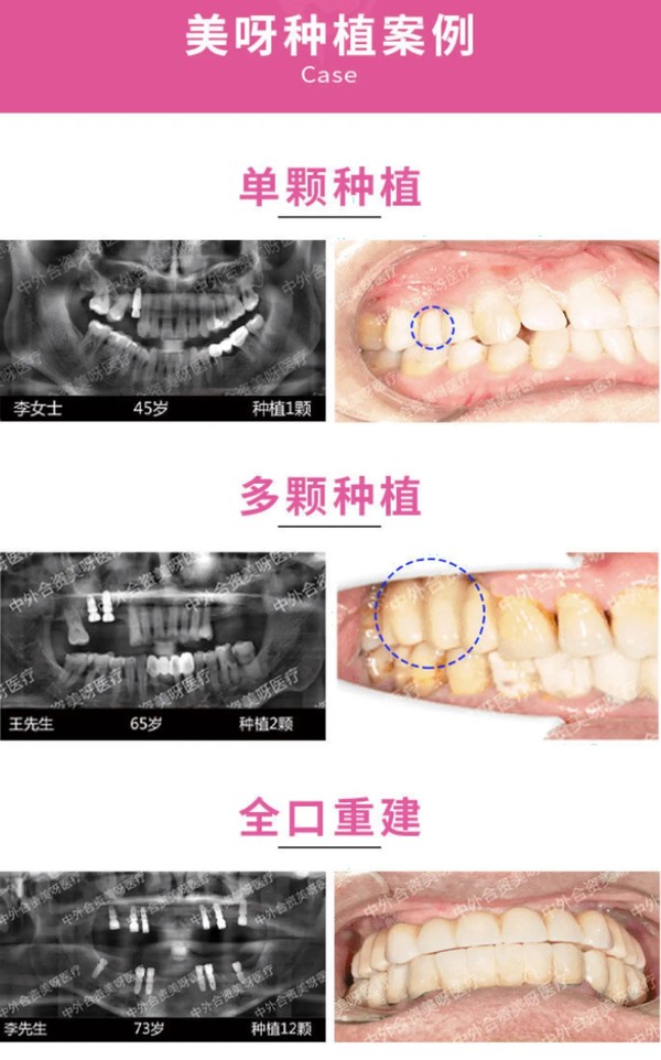 彩虹医生 韩国奥齿泰植牙种植体套餐