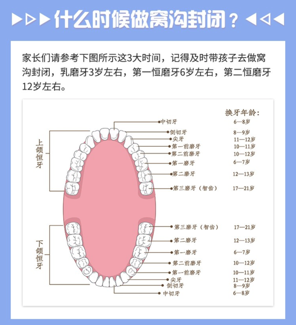 牙管家 儿童进口窝沟封闭 