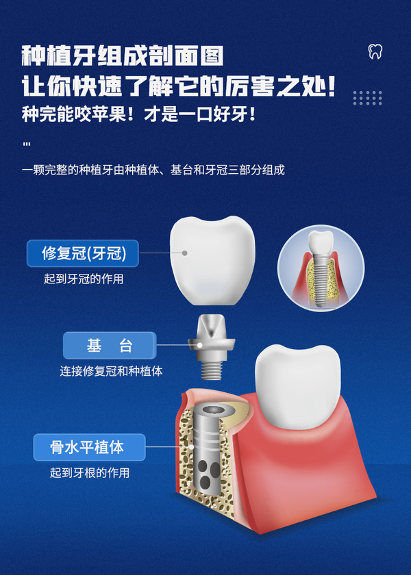 美奥口腔 瑞士ITI种植体+基台+全瓷牙冠