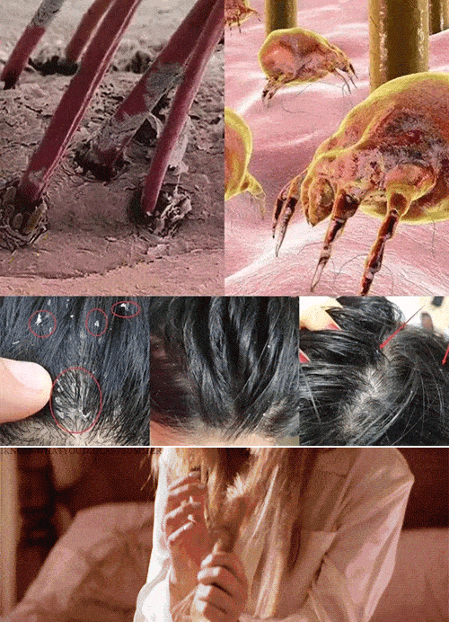 侵蚀头皮,头发也会变得越来越油腻,当头发的毛囊被细菌或者污渍堵塞