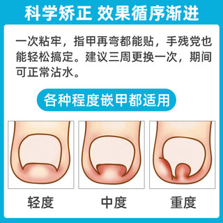 可孚嵌甲矫正器甲沟贴脚炎正甲贴片拉拉修脚专用刀剪指甲纠正神器