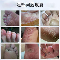 战立克战立克足医生脚气喷剂 脚臭喷雾汗脚脚臭脚痒脚气脱皮水 2盒装 【1贈1共2盒装】中度100%特效